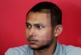 Gương mặt chi chít sẹo của tuyển thủ Malaysia bị tạt axit